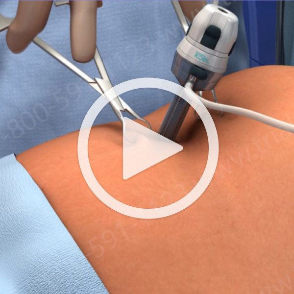 Laparoscopic Trocar Placement Under Direct Visualization Animation